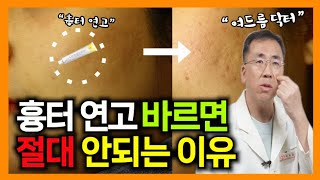 quot흉터 연고quot 절대❗바르면 안되는 이유❗여드름흉터 여드름흉터없애는방법 여드름흉터없애는법 여드름자국 [upl. by Omora]