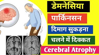 डेमनेसिया l पार्किनसन l दिमाग सुकड़ना l चलने में दिक्कत l Cerebral Atrophy [upl. by Hanah]