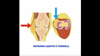 Naprawa łąkotki z cystą Repair of the meniscus lesion with accompanying cyst [upl. by Saffier397]