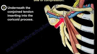 Thoracic Outlet Syndrome  Everything You Need To Know  Dr Nabil Ebraheim [upl. by Pearl]