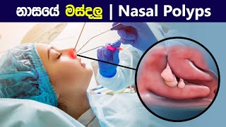 නාසයේ මස්දලු 😨 Nasal polyps and their treatment  How polypectomy is performed  in sinhala [upl. by Fair]