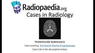 Periventricular leukomalacia Radiopaediaorg Cases in Radiology [upl. by Anniahs]