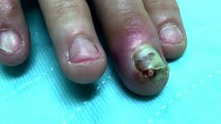 Finger infection Drainage Procedure [upl. by Coucher]