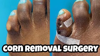 MINIMALLY INVASIVE HAMMERTOE CORRECTION AND CORN EXCISION [upl. by Inavoig]