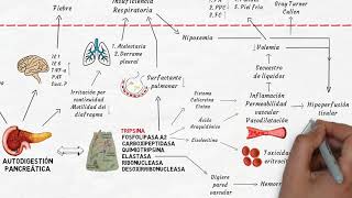 Fisiopatología de la pancreatitis aguda en 6 minutos [upl. by Eiduam]