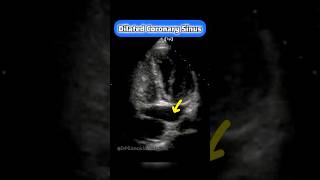 Coronary Sinus on Echocardiography echocardiogram cardiology echo [upl. by Charleton674]