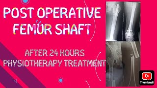 POST OPERATIVE FEMUR SHAFT FACTURE PHYSIOTHERAPY फेमर हड्डी टूटने के बाद व्यायाम कैसे करे [upl. by Corabella]