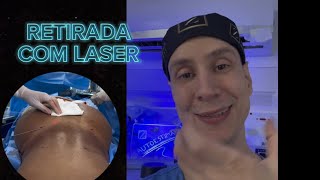 Metacril  PMMA com laser para Retirada [upl. by Maximilien]