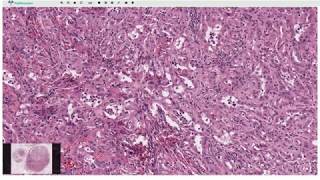 Adenomatoid Tumor  Histopathology [upl. by Eilliw]