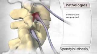 Spondylolisthesis Pathology [upl. by Aldercy638]