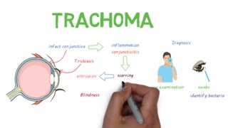 Trachoma  a devastating infectious eye disease [upl. by Terra]