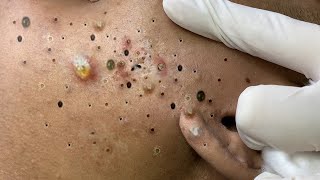 Big Cystic Acne Blackheads Extraction Blackheads amp Milia Whiteheads Removal Pimple Popping  6828 [upl. by Brianne]