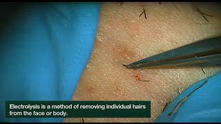 Electrolysis Ingrown Hair Removal  CLOSEUP  Here is how Electrolysis works  Jade Clinics [upl. by Garin]