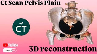 How did you make this  3D reconstruction Ct Scan Pelvis  Ge 32 revolution machine [upl. by Relyuc]