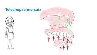 Teleskopzahnersatz  Was ist das  ein Erklärvideo [upl. by Rebmyt284]