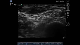 Ultrasound guided Intercostobrachial nerve block [upl. by Laureen290]