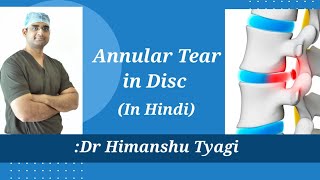 Annular tear in Disc [upl. by Aillij682]