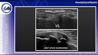 Ultrasound appearance of joint Space narrowing on MSK Ultrasound [upl. by Jessika517]