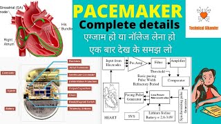 Pacemaker Hindi mekyu lgate h pacemakerpacemaker heart heartbeat [upl. by Ecilahs]