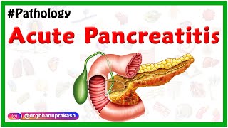 Acute Pancreatitis Etiology  signs and Symptoms pathophysiology  Diagnosis Treatment [upl. by Cannice]