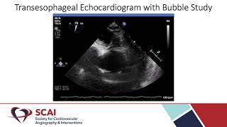 PlatypneaOrthodeoxia Syndrome Following Abdominal Surgery [upl. by Gildea]