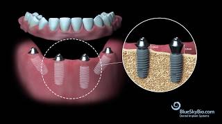 Blue Sky Bio Multi Unit Abutment [upl. by Itnahsa]