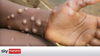 UK Monkeypox cases double to 20 [upl. by Kenji]