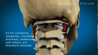 C1 and C2 Atlantoaxial Instability Upper Cervical Instability and Prolotherapy animation [upl. by Nimesh]