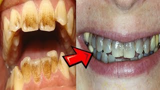 What causes teeth to turn black [upl. by Marabelle]