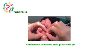 Tratamiento de la hiperqueratosis o clavo en la planta del pie [upl. by Naivat77]