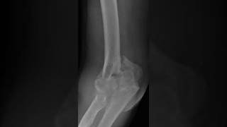 post op fracture of humerus rehab postoperative rehab humerus [upl. by Joiner]