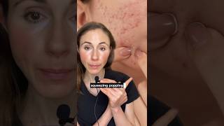 This Might Be Sabotaging Your Acne Journey dermatologist [upl. by Arhna495]