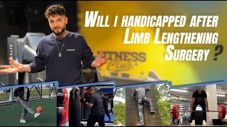 WILL I HANDICAPPED AFTER LIMB LENGTHENING SURGERY [upl. by Odrareg]