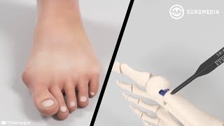 Minimally Invasive Bunion Surgery Percutaneous Bunionectomy [upl. by Oluap]