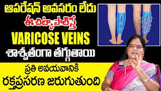 Dr Poorna Rajeshwari  How to Reduce Varicose Veins Without Surgery  Nerve Swelling  iDream [upl. by Ajnat]