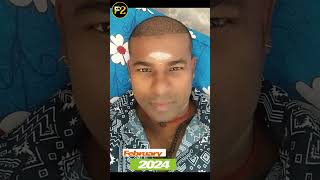 REVEALING MY HAIR TRANSPLANT JOURNEY 💥🔥 F2HairTransplantandSkinCare clinic Velachery Chennai [upl. by Zehe792]