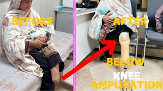 Inspiring Transformation  Mom with Baby Having Below Knee Leg Amputation [upl. by Atiniv]