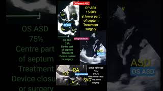 Different types of ASD  Atrial septal defect Echo asd echo shorts [upl. by Edette770]