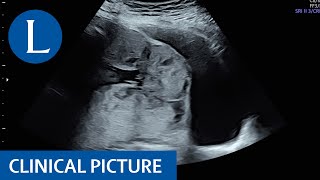 Placenta accreta spectrum in a 37yearold woman [upl. by Mikal92]