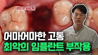 모든걸 다 잃게 되는 최악의 임플란트 부작용 여러분의 임플란트는 안전하신가요 [upl. by Buna779]