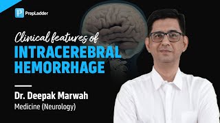 Clinical features of Intracerebral Hemorrhage by Dr Deepak Marwah [upl. by Rusell]