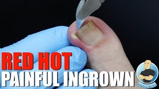 INGROWN TOENAIL REMOVAL WITH A GOOEY SURPRISE [upl. by Schell]