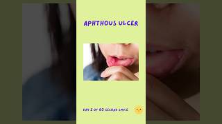 Mouth Ulcers [upl. by Samoht]