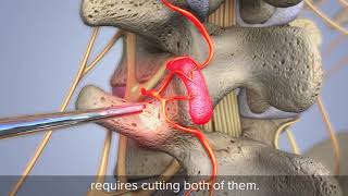 Direct Visualized Rhizotomy is an endoscopic procedure for back pain  Animation [upl. by Greenfield888]