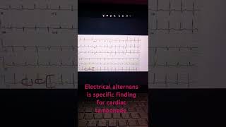 Electrical alternans in ecg [upl. by Tihor]