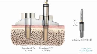 Astra Tech Implant System™ EV Guided surgery – cortical drilling with tube  Dentsply Sirona [upl. by Alecram91]