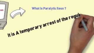 What Is Paralytic Ileus and Ways Of Ileus Treatment [upl. by Osmen]