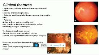 idiopathic chorioretinopathies [upl. by Mcnally344]