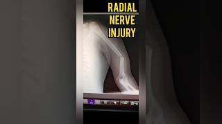 Radial Nerve Injury after Humerus Fracture Wrist amp Finger Drop  Dr Prateek Joshiortho fracture [upl. by Otsugua797]