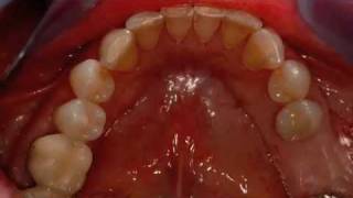 Dental Implant Surgery in a Preserved Site  Singh quotGPSquot Trephine System [upl. by Aned]